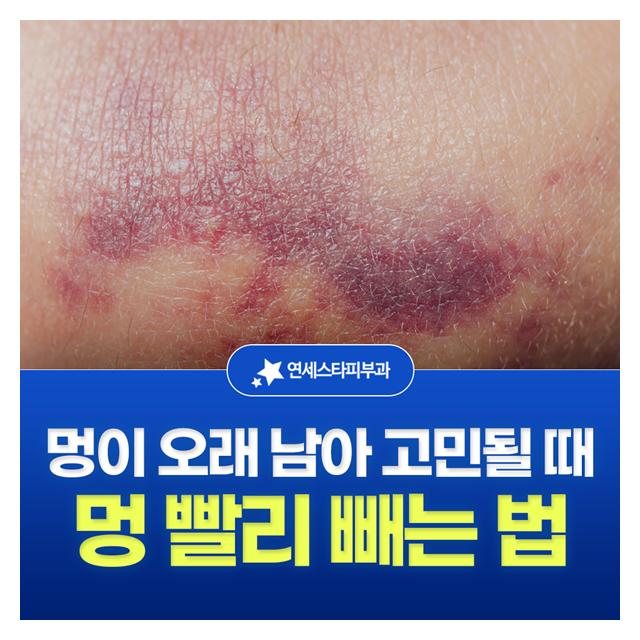 멍 빨리 빼는 법, 멍이 오래 남아 고민될 때 연세스타피부과